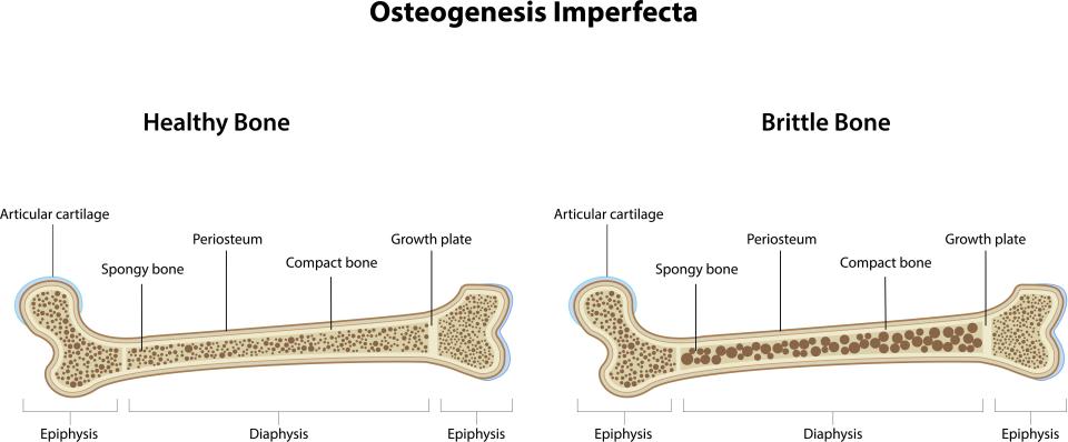  Osteogenesis Imperfecta, also known as Brittle Bone disease, is a genetic condition characterised by bones that break easily