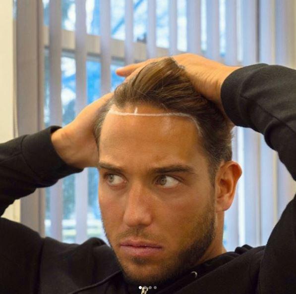  James recently revealed he had undergone a hair transplant