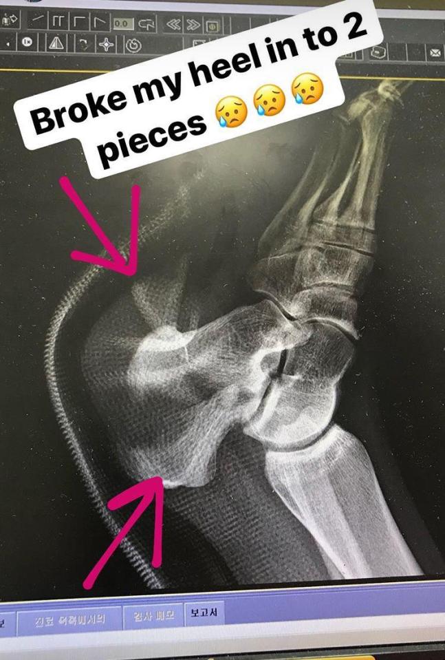  Katie Ormerod shared the x-ray which showed the extent of her injury