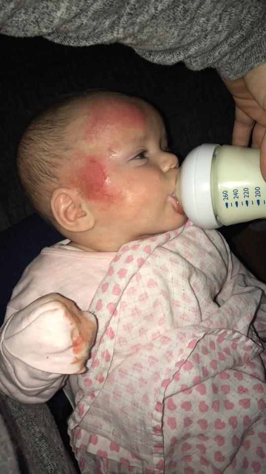  Kelisha began to suffer from eczema when she was three months old