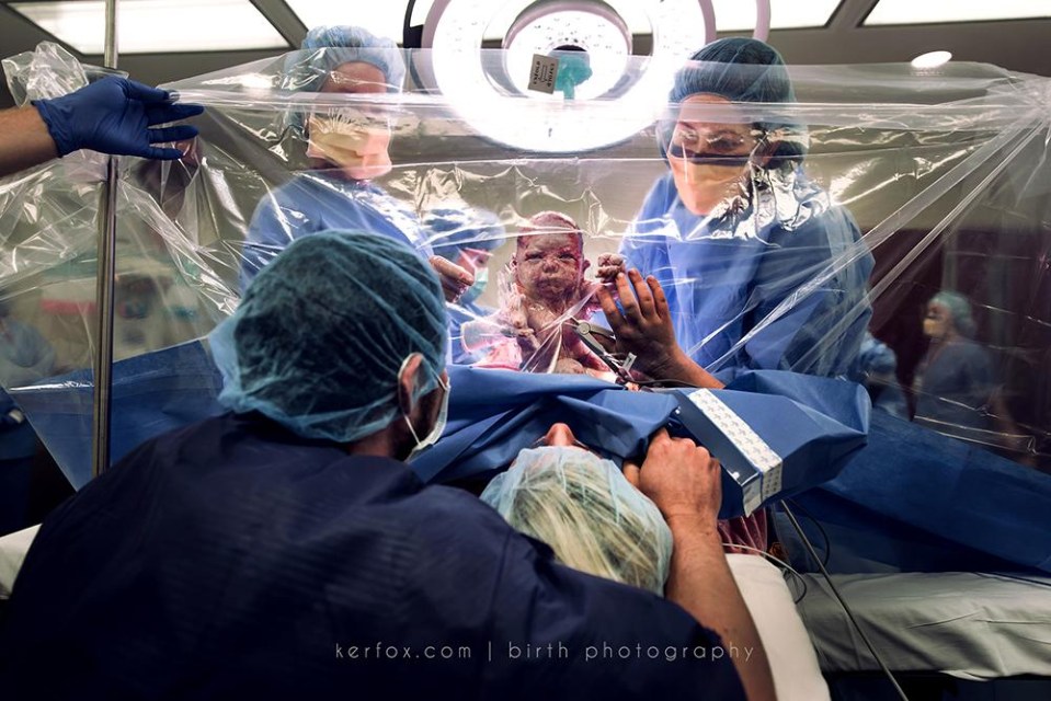 A baby born by C-section sees its parents for the first time... through a piece of plastic sheet