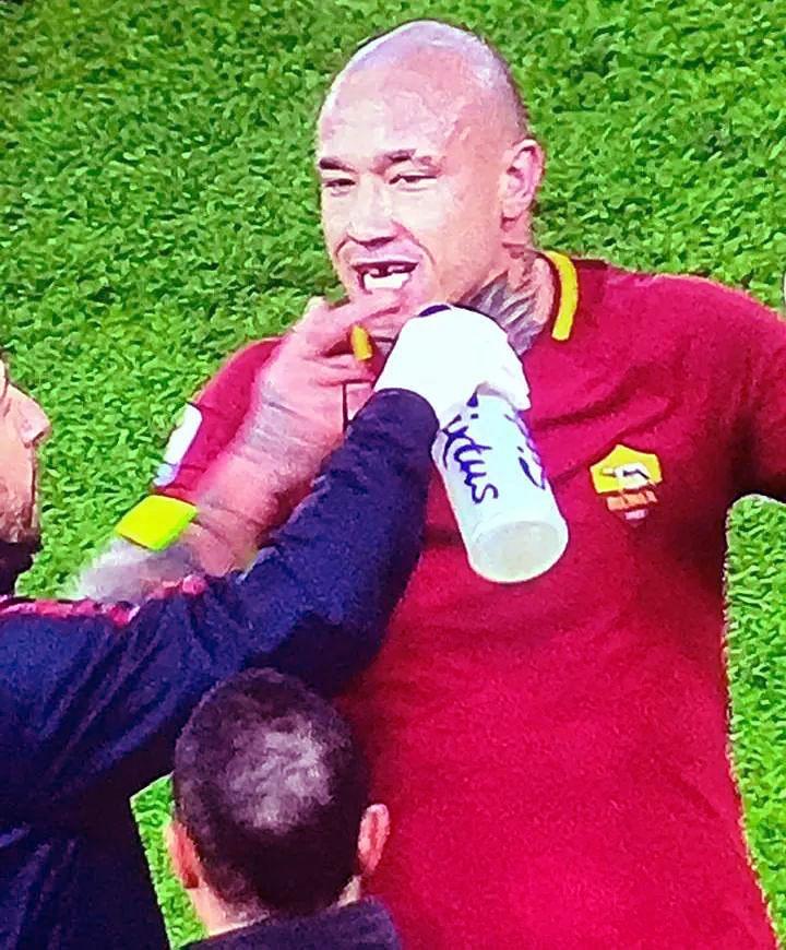  Radja Nainggolan had his tooth knocked out during Roma's clash with AC Milan