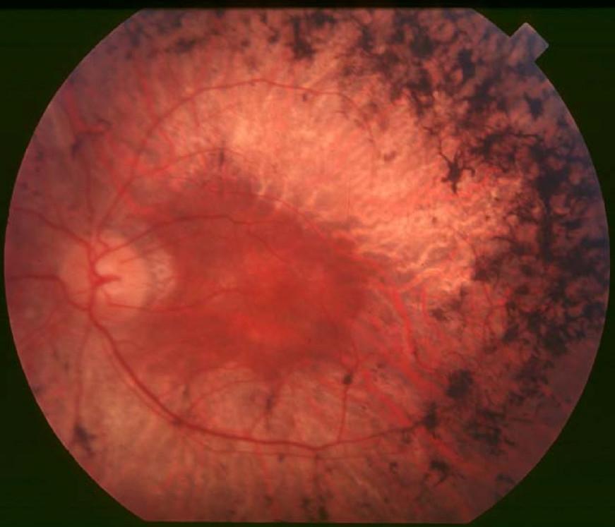 Fundus of a patient with mid-stage retinis pigmentosa