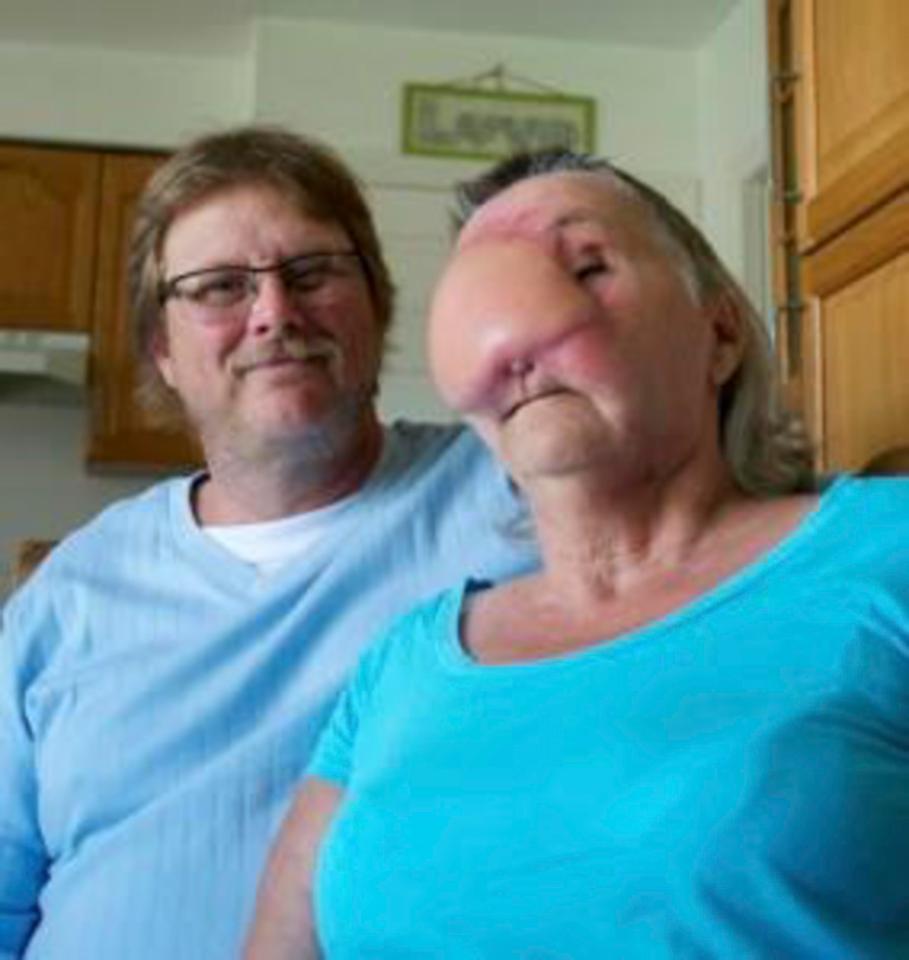  Ida, pictured with Randy, has undergone several operations to reconstruct her face