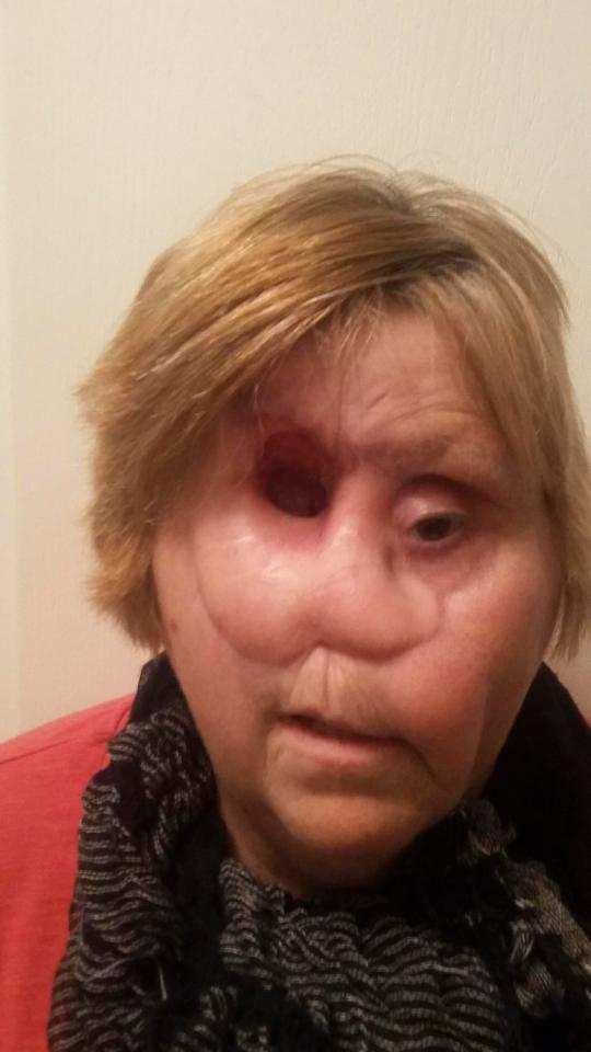  Doctors were forced to remove Idas nose when they realised her cancer had spread