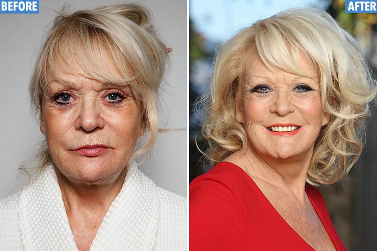  Sherrie Hewson lost seven years from her face after the process