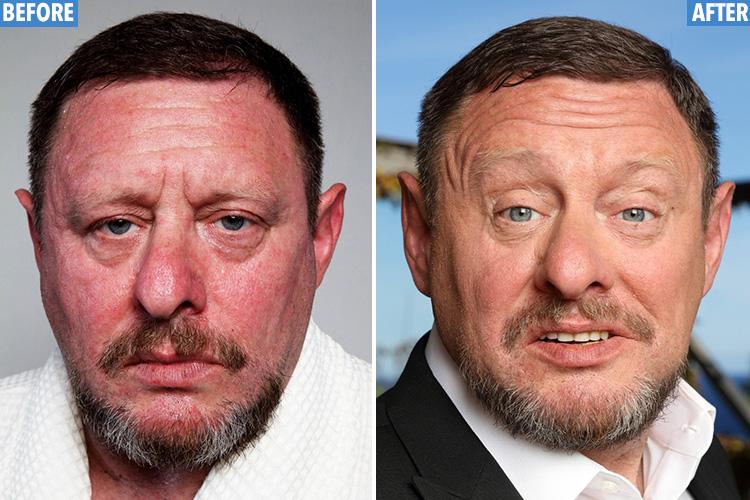  Shaun Ryder had laser treatment to help change his face age from 64 to 59