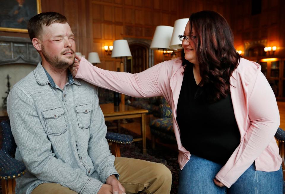  Sandness met Lilly, who had agreed to donate her high school sweetheart's face to him, who lived nearly a decade without one