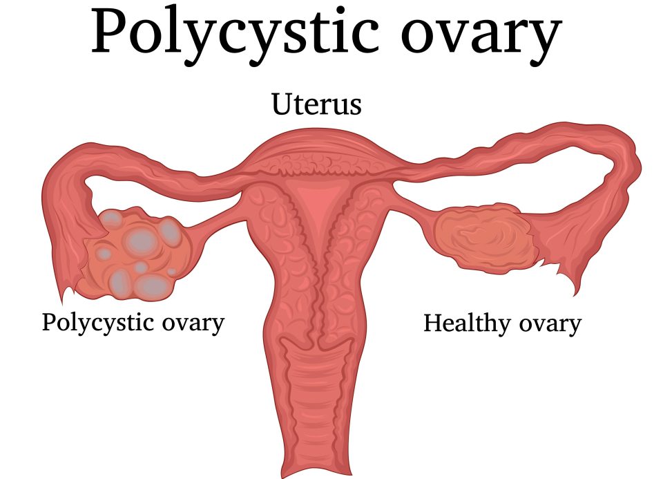  If the tissue surrounding a woman's ovary is not developed properly then a woman is unable to release an egg during her monthly cycle