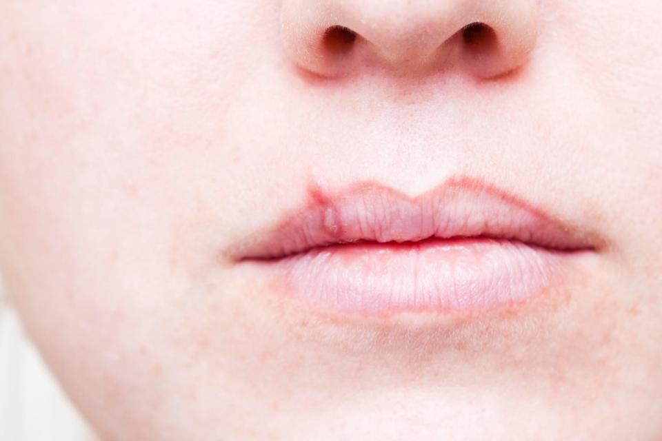 Researchers believe that the more flair up of the cold sore virus someone has, the more likely they are to develop the killer disease.