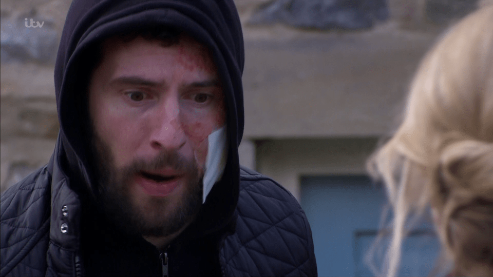  Ross is still struggling to come to terms with what has happened to him after the acid attack