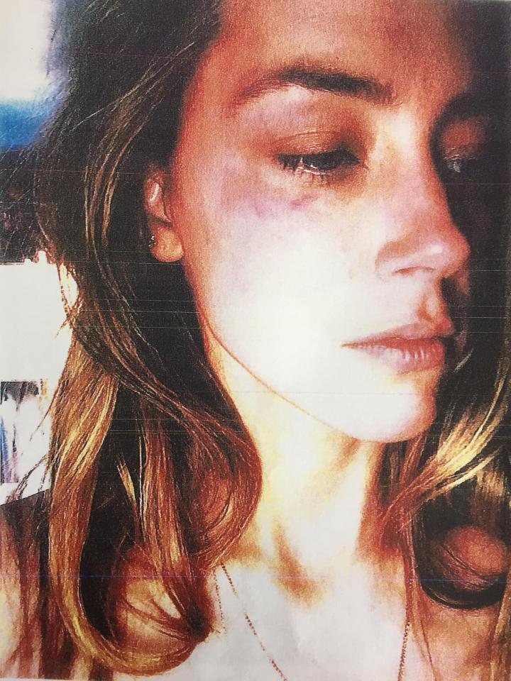  Amber Heard produced a huge amount of evidence outlining the abuse - including shocking pictures of bruising on her face