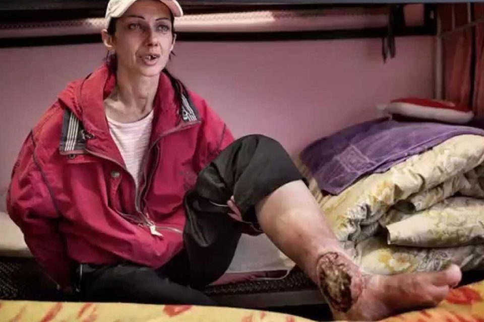  The drugs horrifying effects can be seen in this image of a junkie in Russia, with 'crocodile' scales forming on her leg