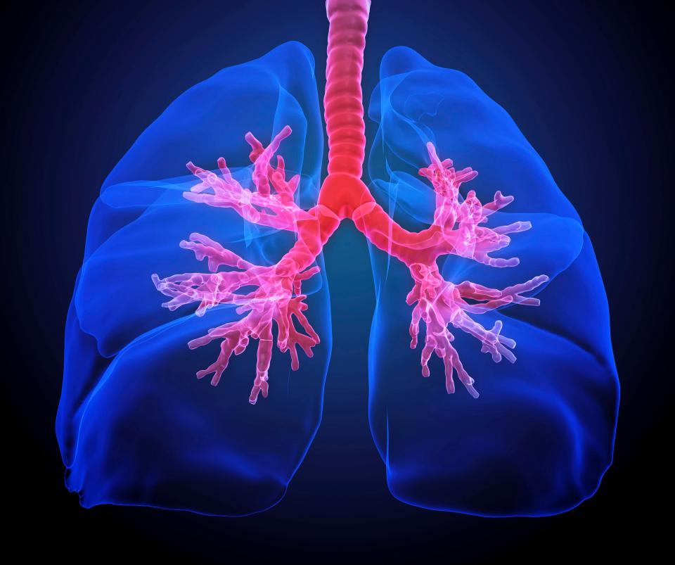 Asthma is caused by inflammation of the breathing tubes that carry air to and from our lungs