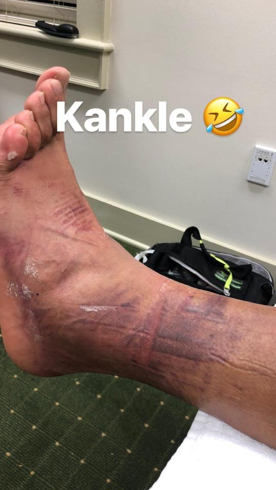  Tony Finau shows off the gruesome effects of his hole-in-one celebration