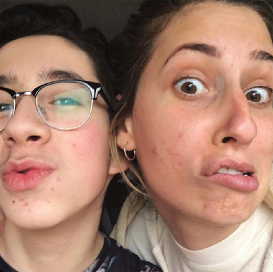 Stacey and her 13-year-old brother Josh shows their spots. She jokes she’s going through ‘quarter life puberty’