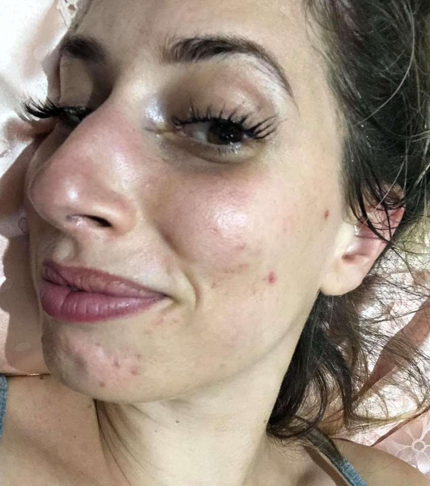 Fabulous columnist Stacey Solomon reveals her skin woes and what it’s like to live with adult acne