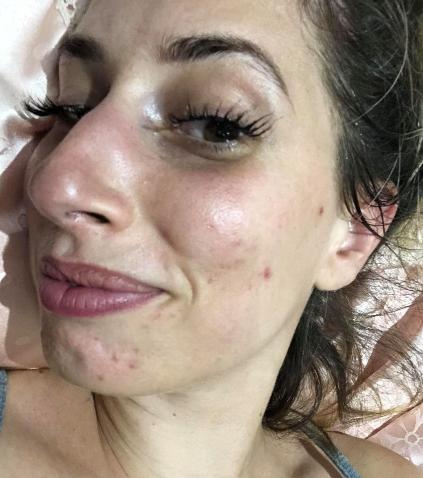  Fabulous columnist Stacey Solomon reveals her skin woes and what it's like to live with adult acne