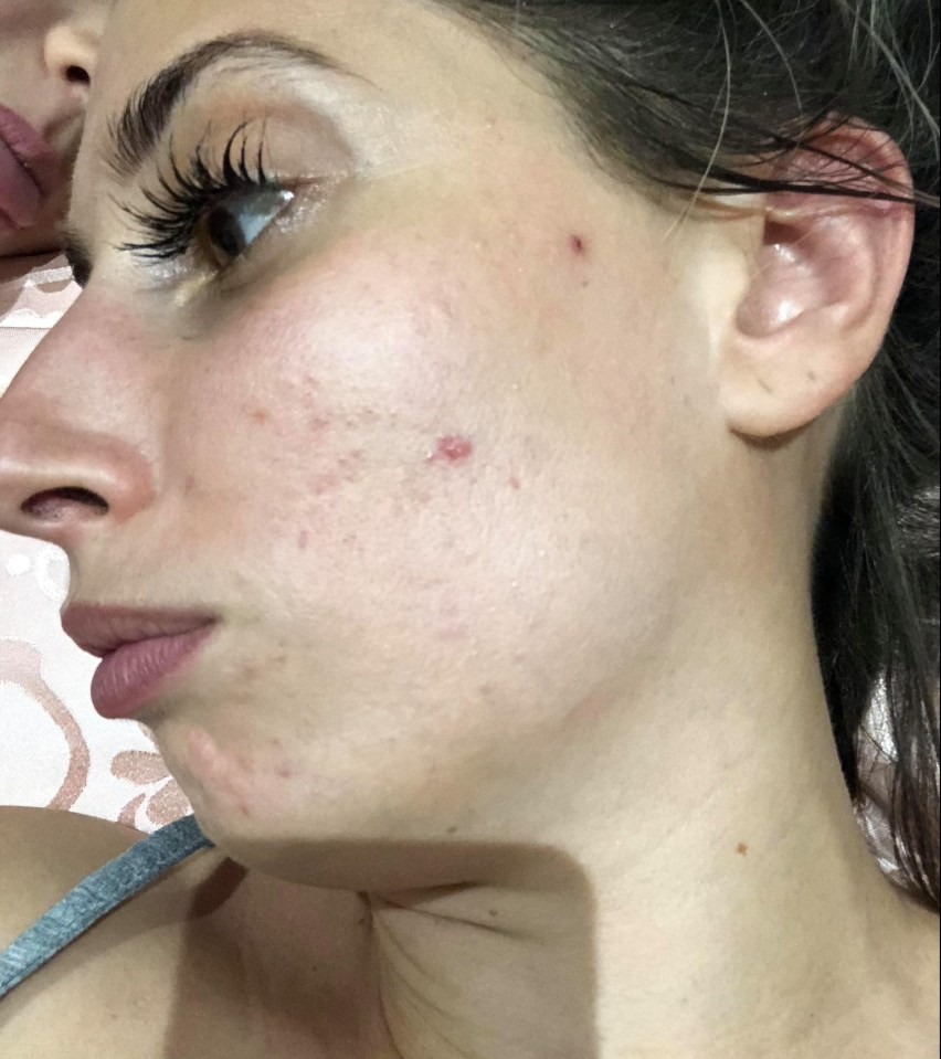 Stacey suffers from breakouts regularly and has scars on her cheeks from some of the stubborn spots