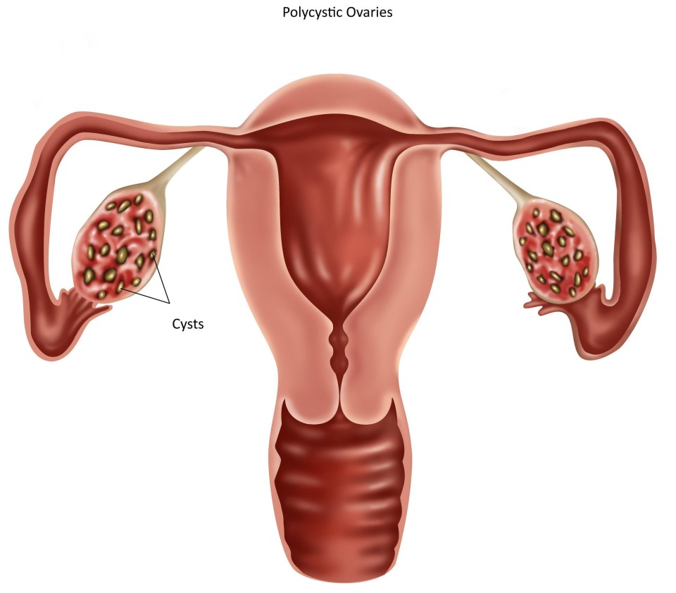 PCOS is a condition caused by hyperandrogenism, where there are cysts around the ovaries and can be linked to infertility