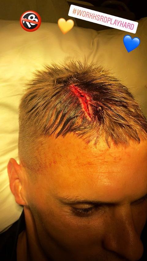 This was the result of the collision that left Martin Skrtel needing ten stitches