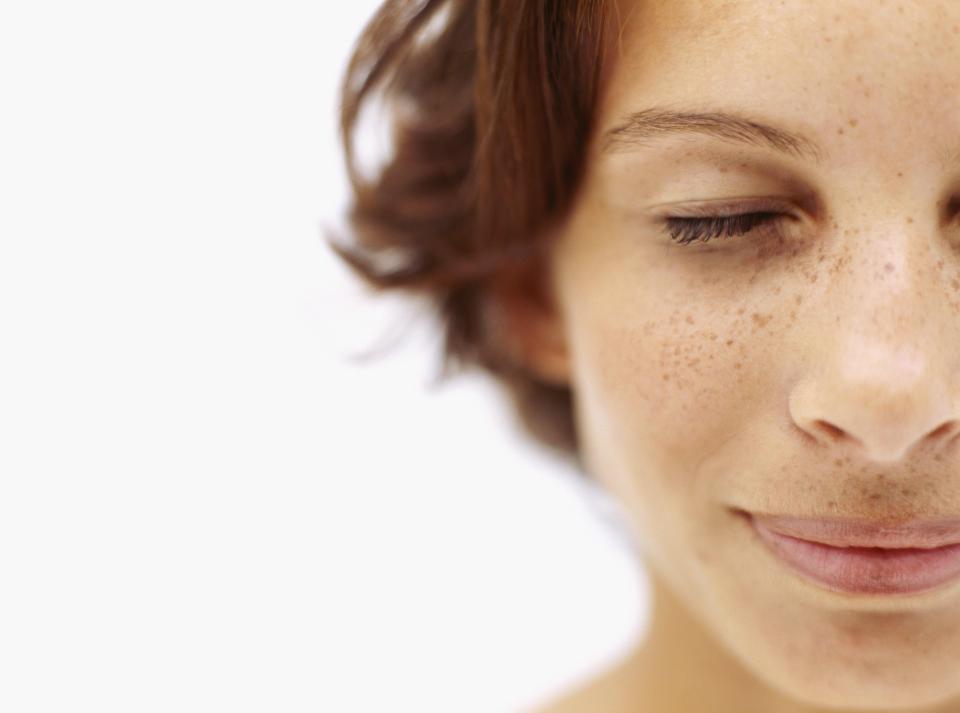  Freckles come out in the sun due to an increased level of melanin in the skin