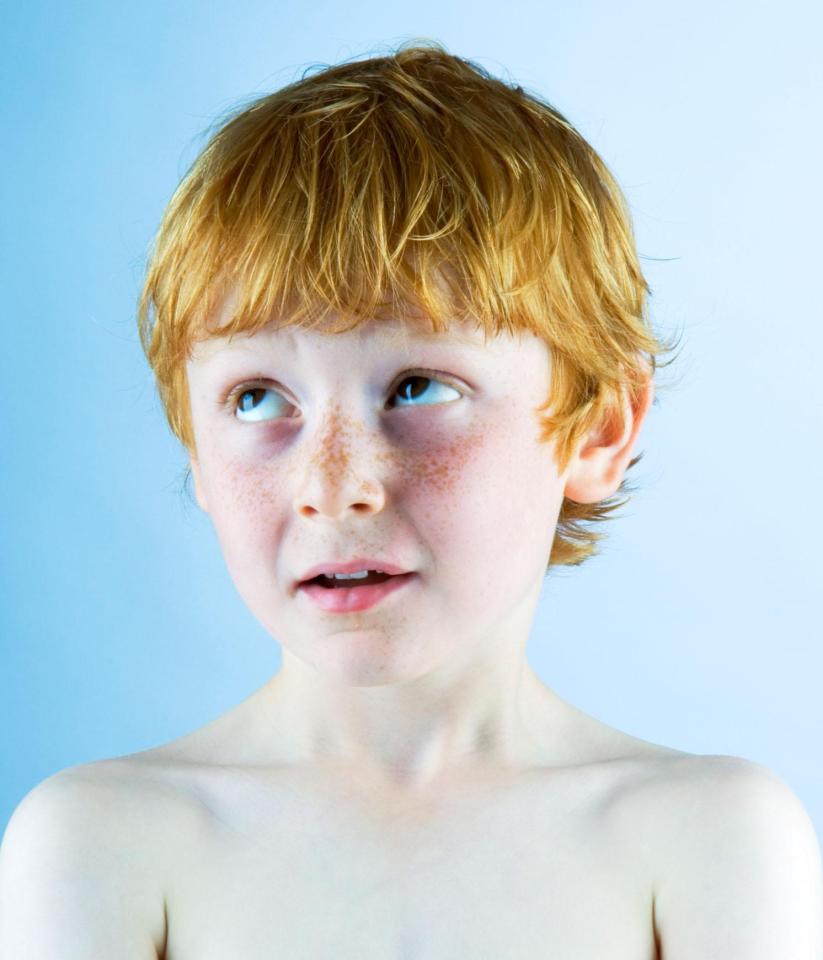  Those with fair skin and hair are more likely to develop freckles in the sun