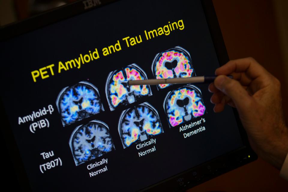  The effects of atrial fibrillation and carotid artery disease increase dementia risk, according to the new study