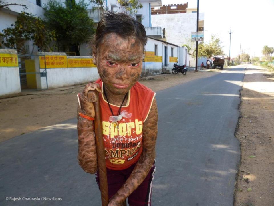 The family are crowdfunding for treatment after hearing about the plight of Shalini Yadav, an Indian teenager whose lamellar ichthyosis was cured by treatment in Spain