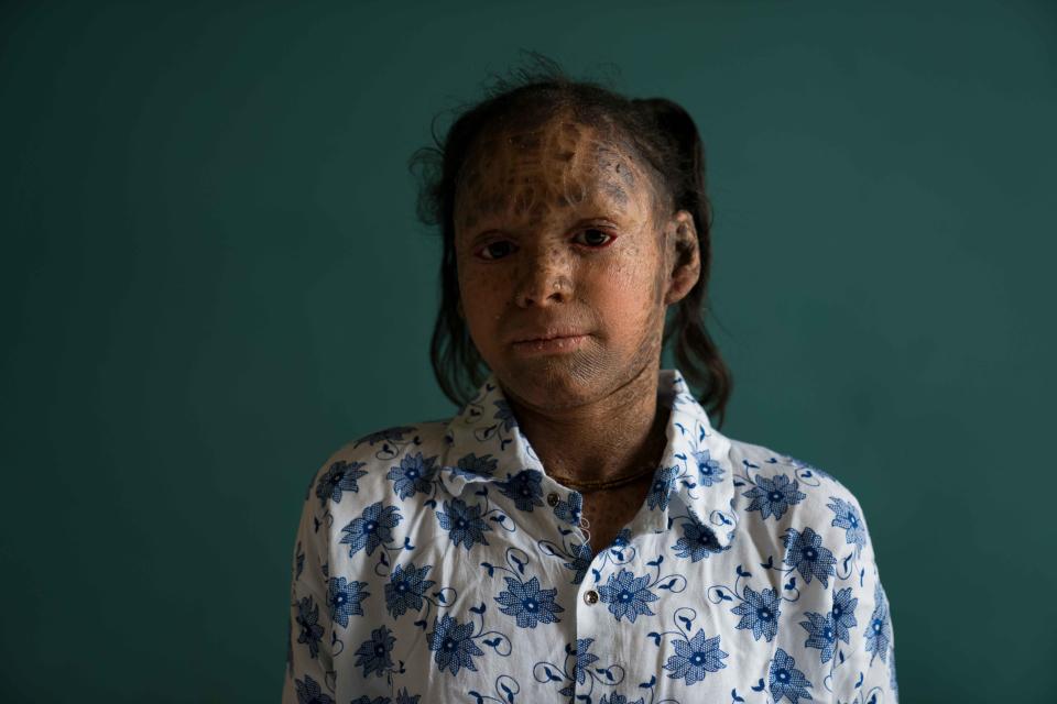 Vedika's condition means her skin doesn't shed properly