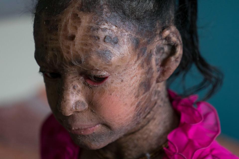 Vedika has ichthyosis, a condition that leaves her covered in scales