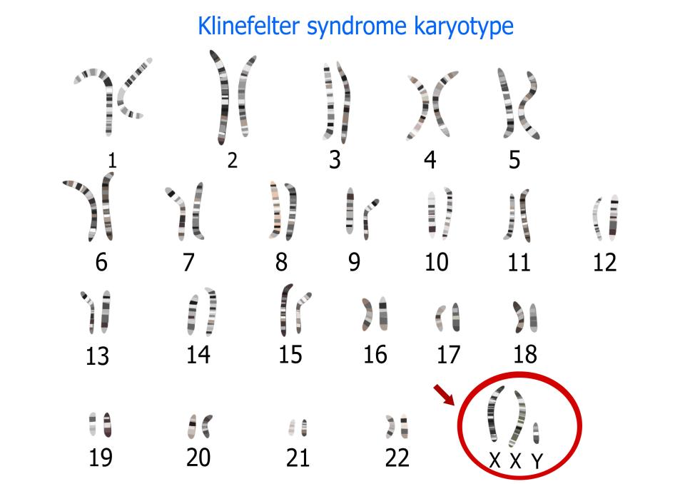 Klinefelter syndrome occurs when males have an extra X chromosone