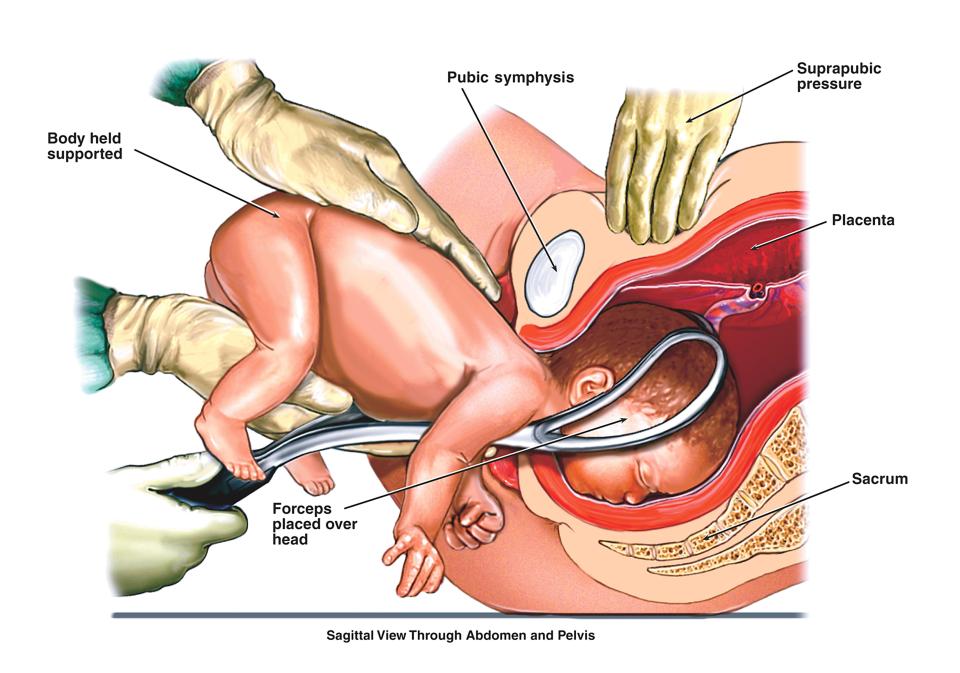  A breech birth occurs in around 1 in 25 full-term pregnancies