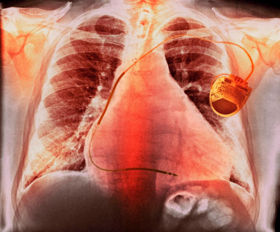  Pacemakers are one of the ways to regulate a patient's heartbeat