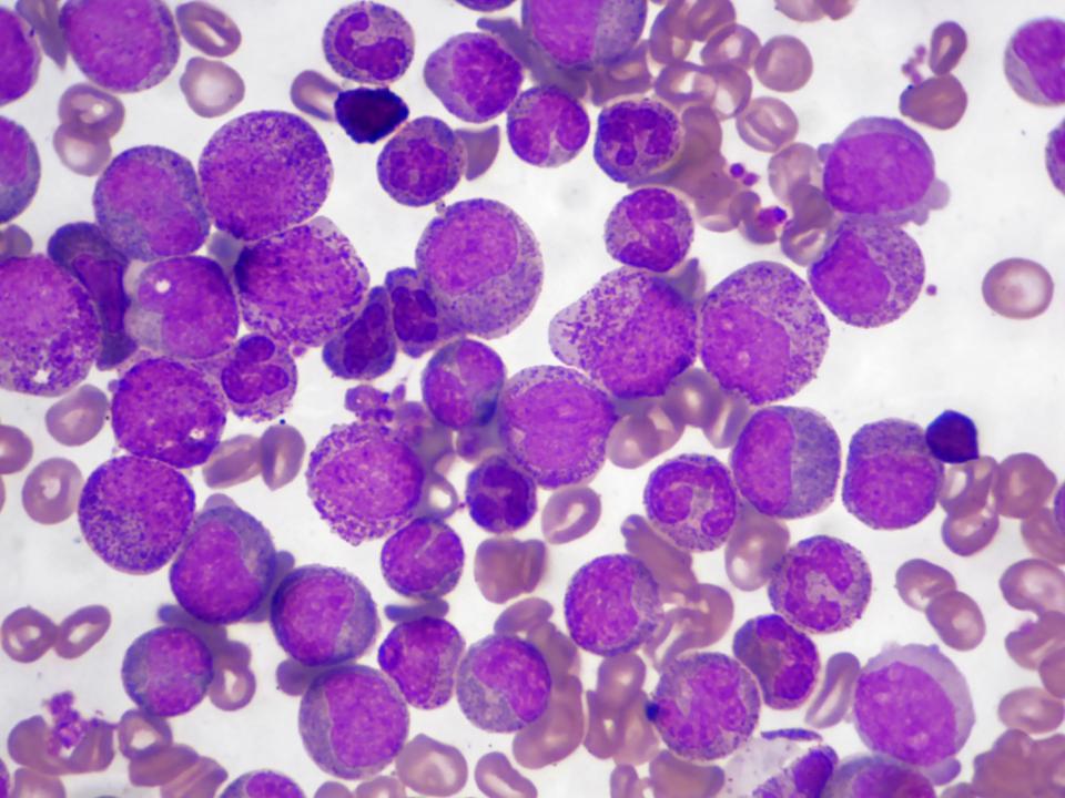 Acute lymphoblastic leukaemia (ALL) is preventable if children’s immune systems are “primed” by their first birthday, experts say