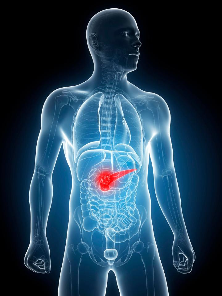  Most cases of pancreatic cancer are found in people aged 75 or over