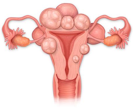 Uterine fibroids may cause irregular bleeding, heavy periods, pain and cramps in the pelvis