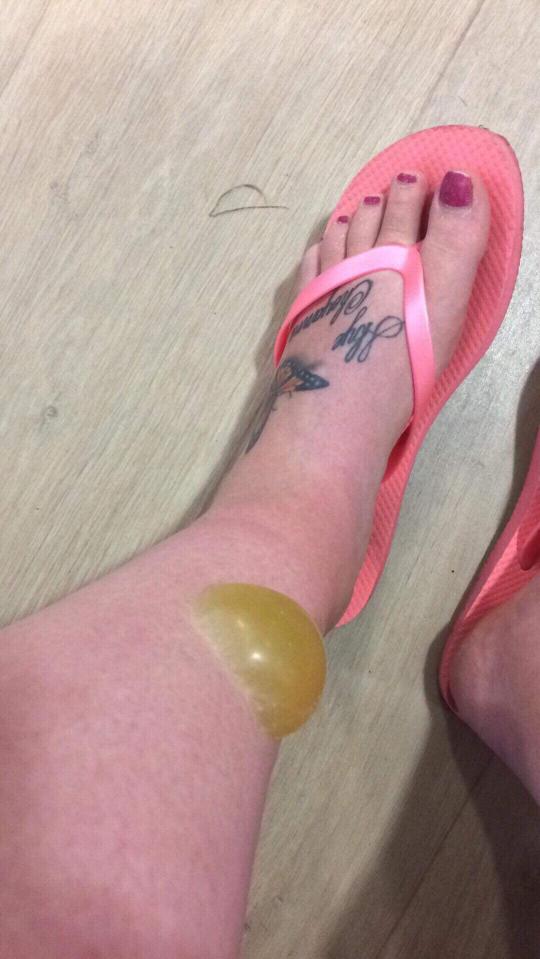 The blister continued to grow and Colette worried about it getting infected