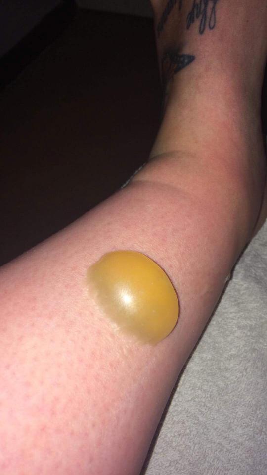 The next day she noticed a yellow blister on her leg that grew to the size of a snooker ball