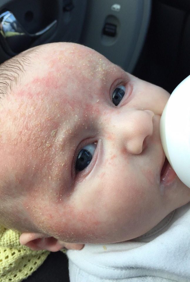 Harris suffers with eczema that leaves his skin dry and flaky