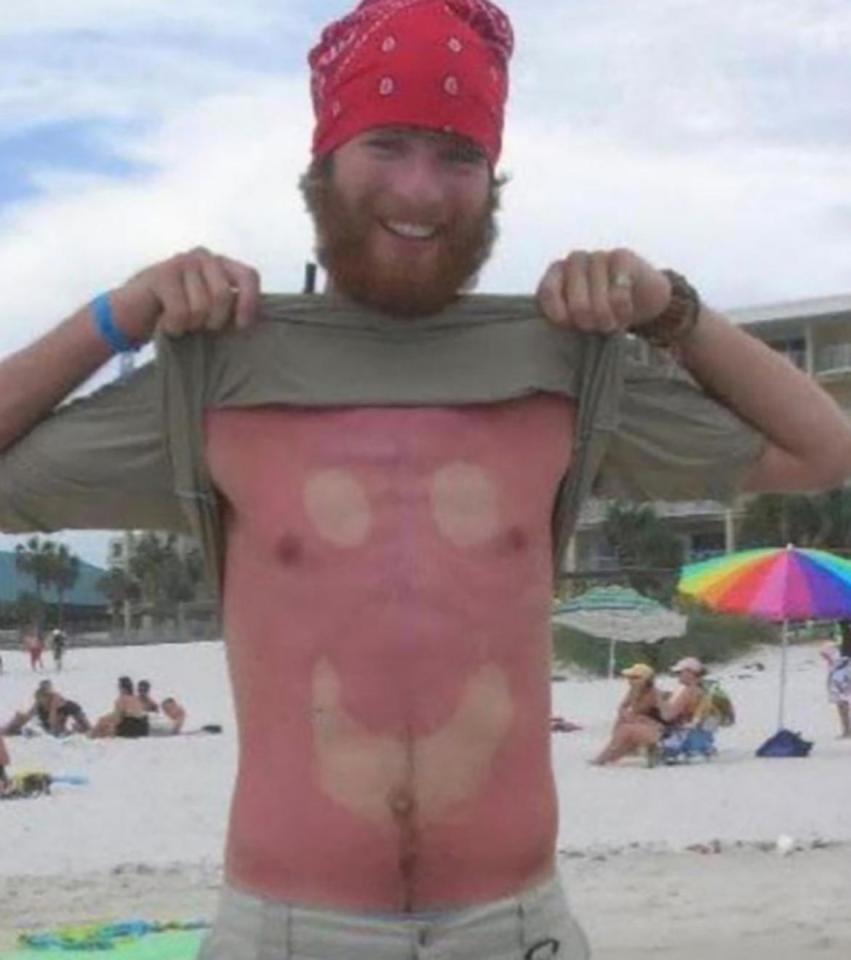  This man fell victim to his pal's artistic use of sun-cream