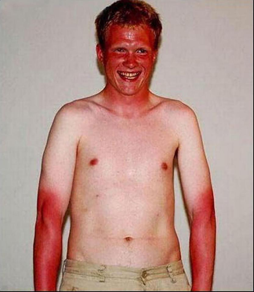  And last but not least... This man is a walking, talking object lesson in why gingers should stay clear of the sun