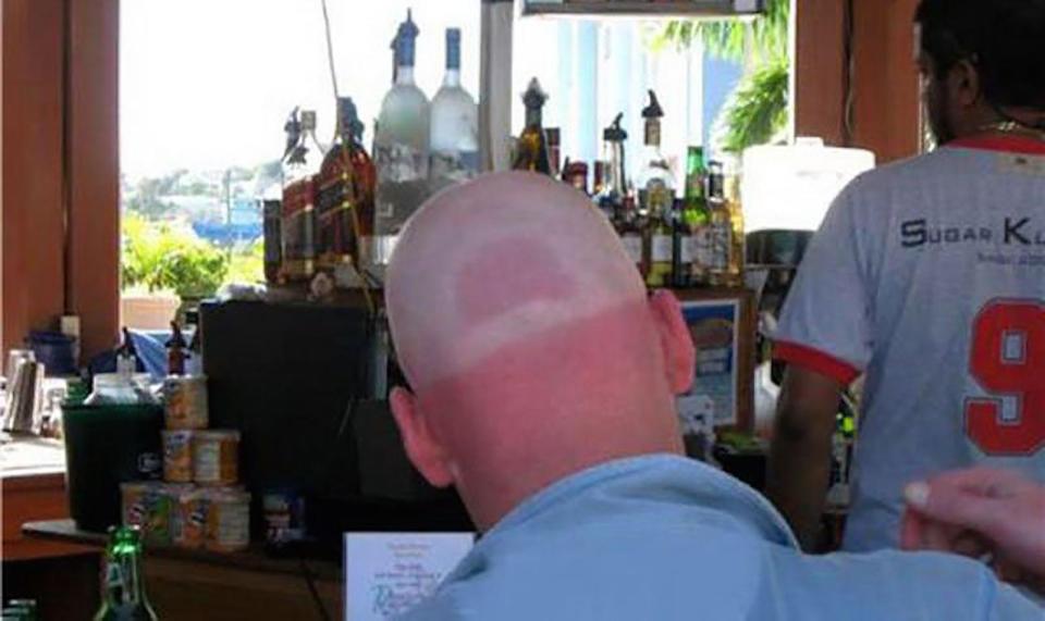  At least this pale skinned fella wore a hat in the sun