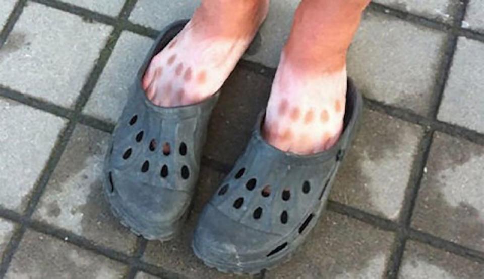  Footwear scare... Here we see for ourselves the perils of wearing your Crocs without your sunblock