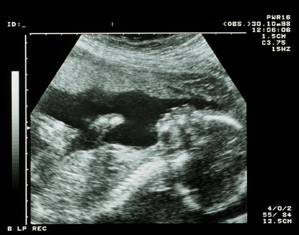  You can see a 2D image of your growing baby at the 20 week scan