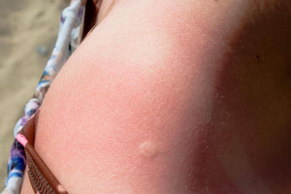  Bee stings can cause itching and swelling