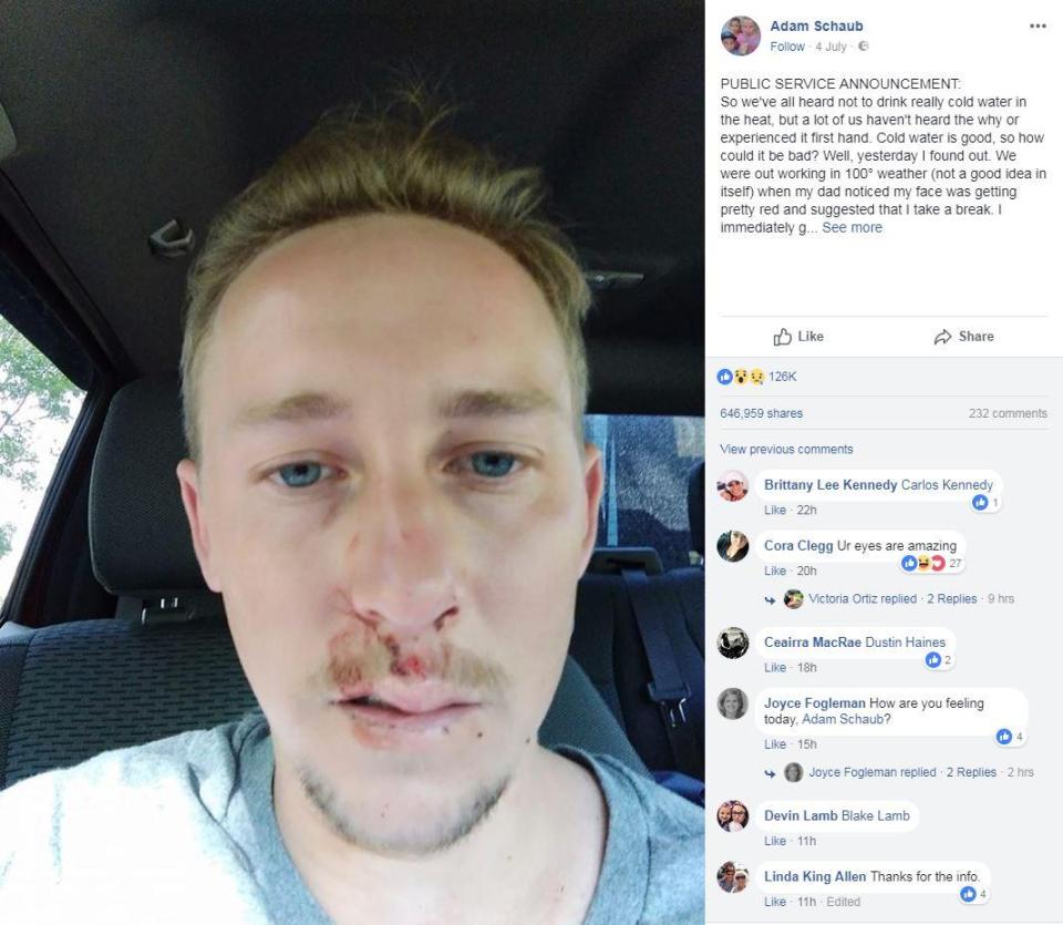 He posted to Facebook warning others of the dangers of drinking freezing cold water in the heat - after he passed out and banged his face