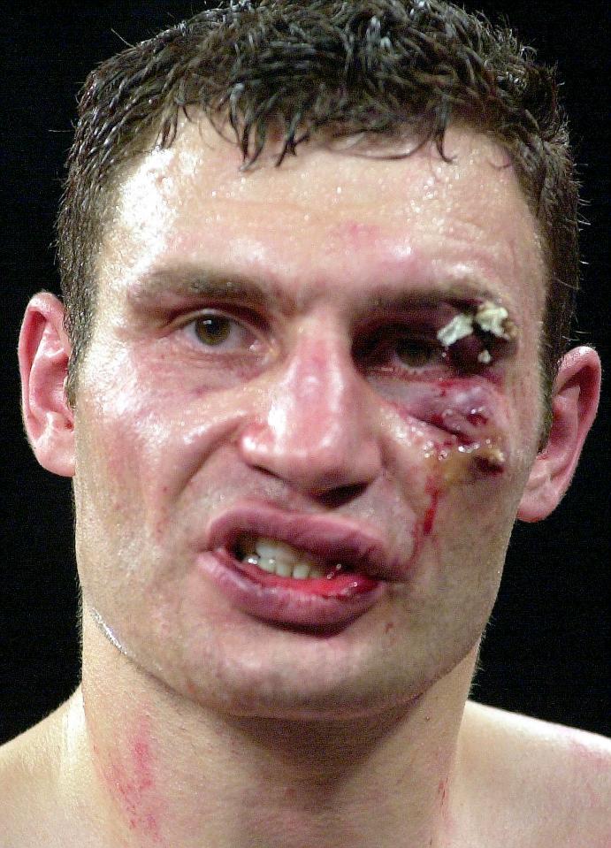 Vitali Klitschko believes he would have won the fight back in 2003 if a horrendous cut didn't see it waved off