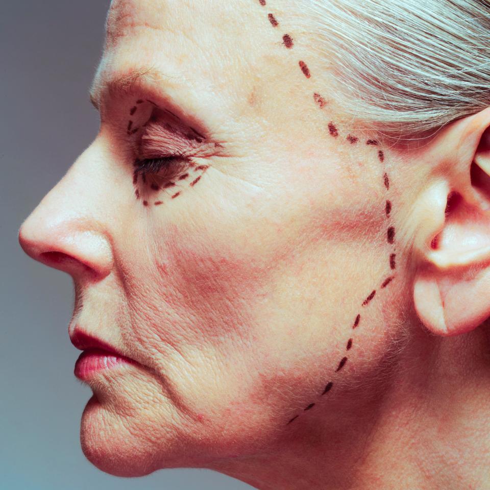  A facelift procedure can cost in the region of £10,000 in the UK