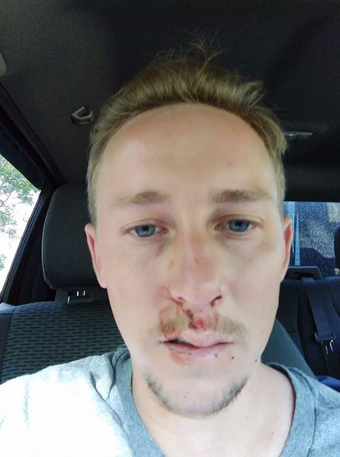 Adam Schaub was left with a nasty bruise on his face, after drinking iced water to cool down at work